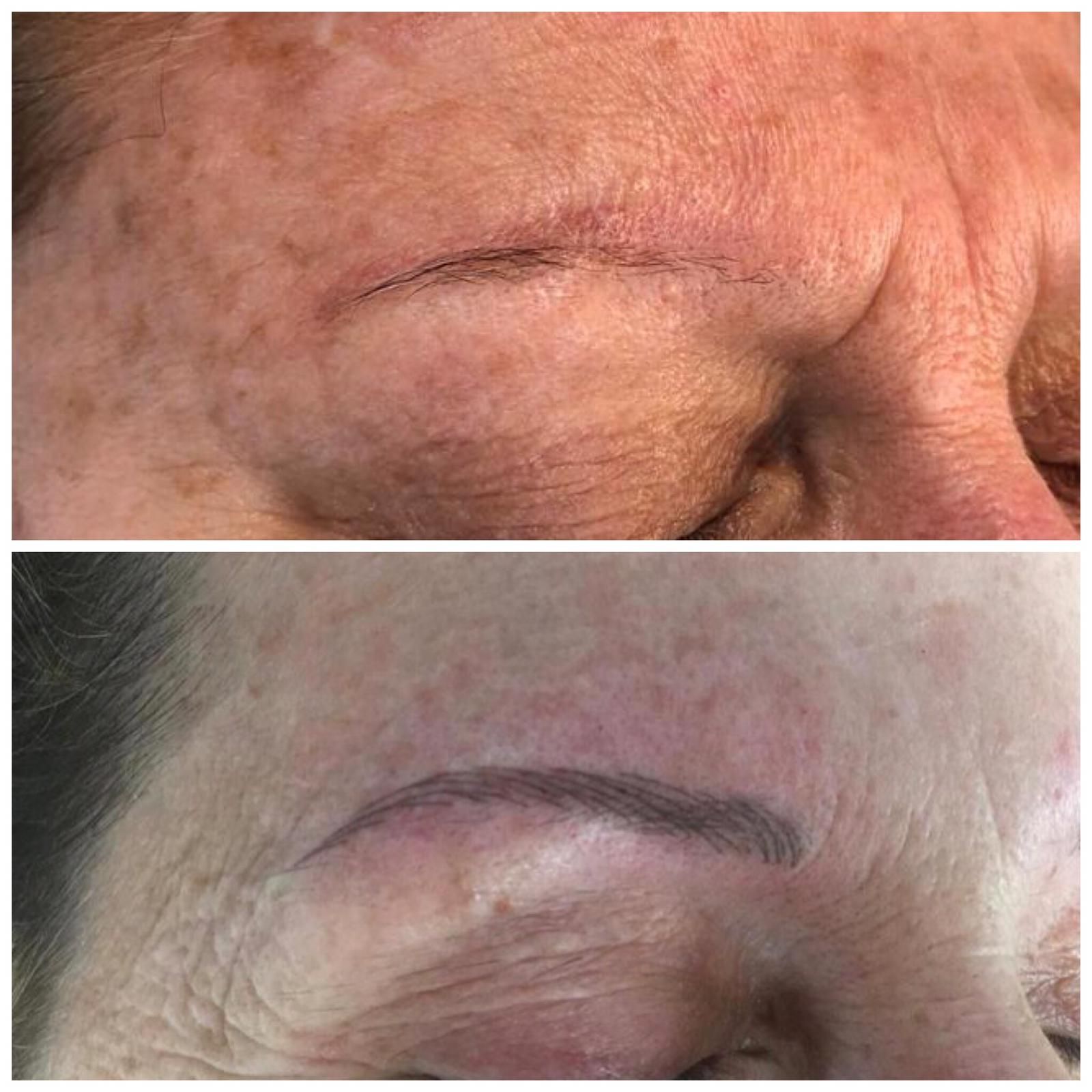 Micropigmentación Barcelona: Patologías y tratamientos de Centro Dermatológico Dr. Javier Bassas Micropigmentación Barcelona: Patologías y tratamientos de Centro Dermatológico Dr. Javier Bassas