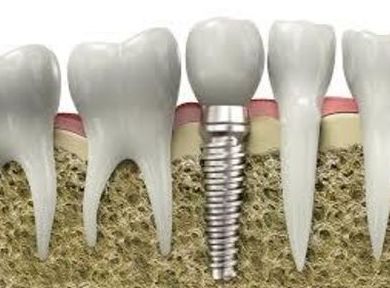 Implantología dental Bilbao
