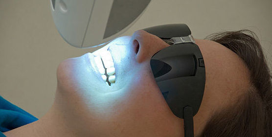 Blanqueamiento dental : Tratamientos de Abad Clínica Dental Blanqueamiento dental : Tratamientos de Abad Clínica Dental