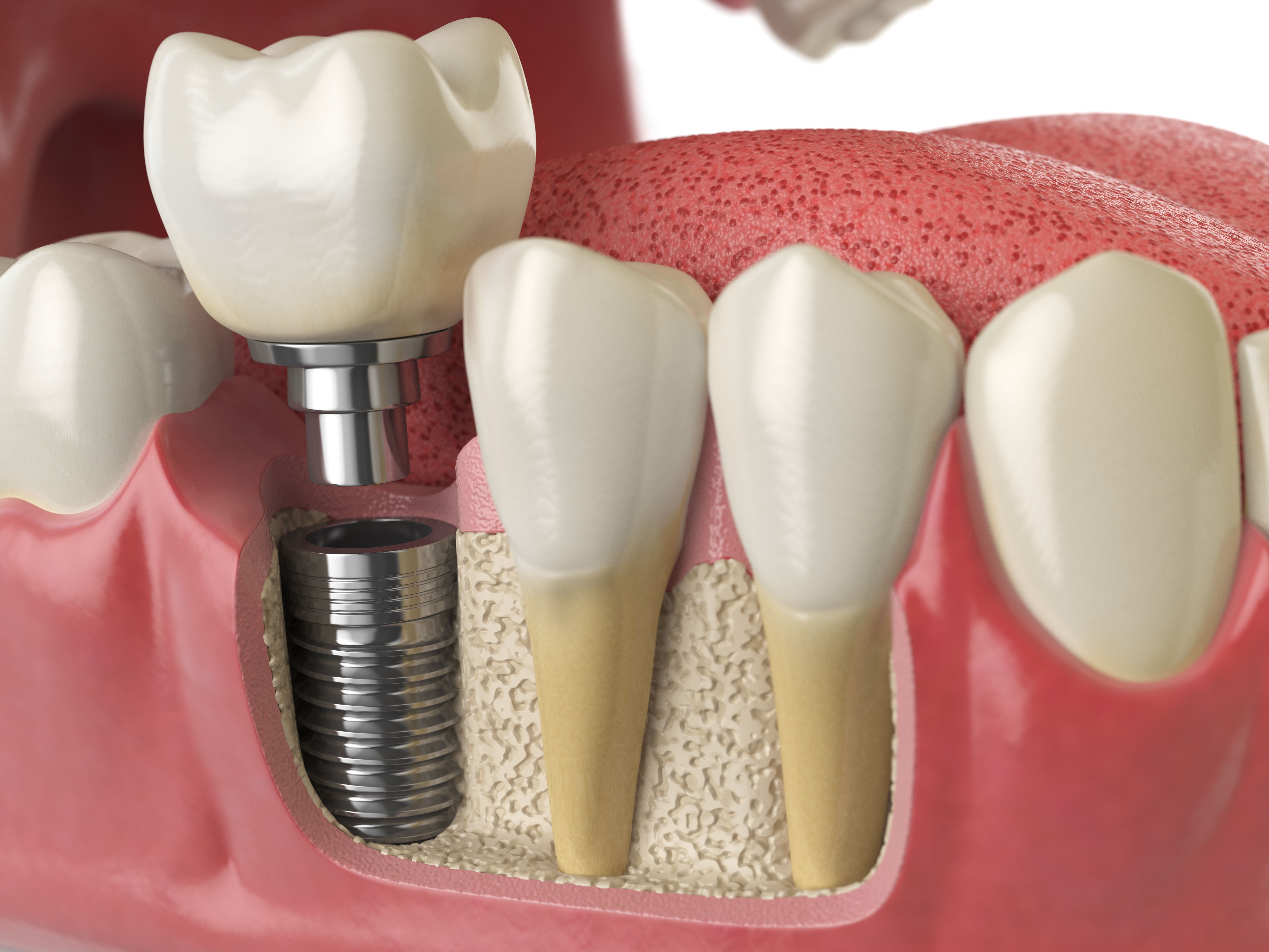 Especialistas en prótesis fija: Servicios de Humanes Dental Especialistas en prótesis fija: Servicios de Humanes Dental