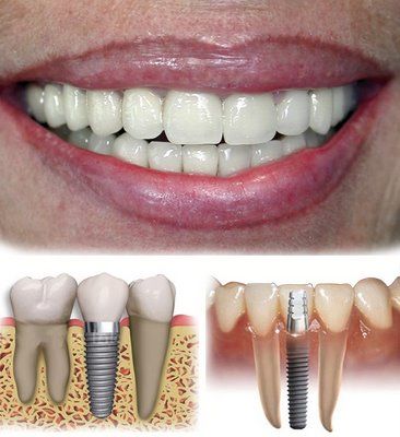 IMPLANTES DENTALES. IMPLANTES DENTALES.