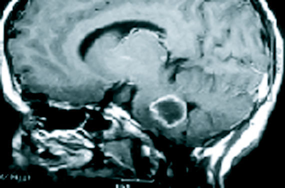 Adenomas : Especialidades y publicaciones de Doctor Villarejo Adenomas : Especialidades y publicaciones de Doctor Villarejo