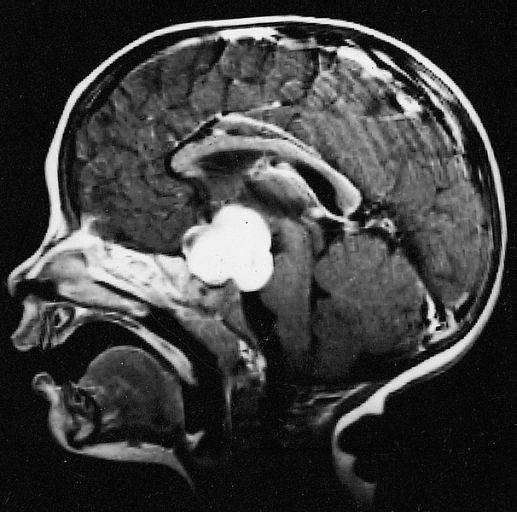 Astrocitomas I : Especialidades y publicaciones de Doctor Villarejo Astrocitomas I : Especialidades y publicaciones de Doctor Villarejo