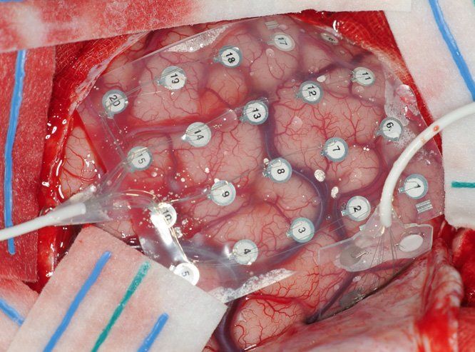Epilepsia: Especialidades y publicaciones de Doctor Villarejo Epilepsia: Especialidades y publicaciones de Doctor Villarejo