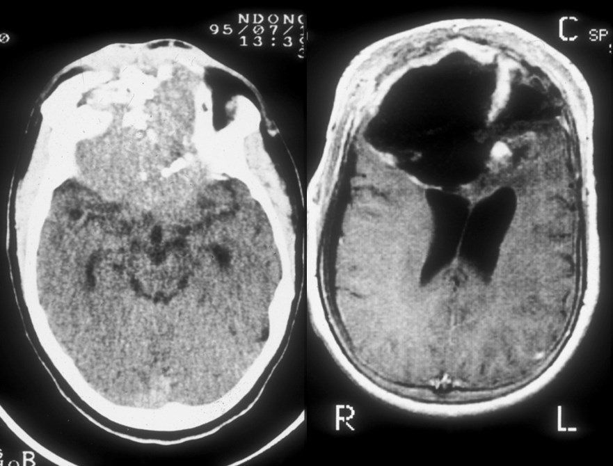 Patología craneoencefálica: Especialidades y publicaciones de Doctor Villarejo Patología craneoencefálica: Especialidades y publicaciones de Doctor Villarejo