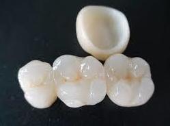 Corona zirconio: Tratamientos de Clínica Dental Tucán Corona zirconio: Tratamientos de Clínica Dental Tucán