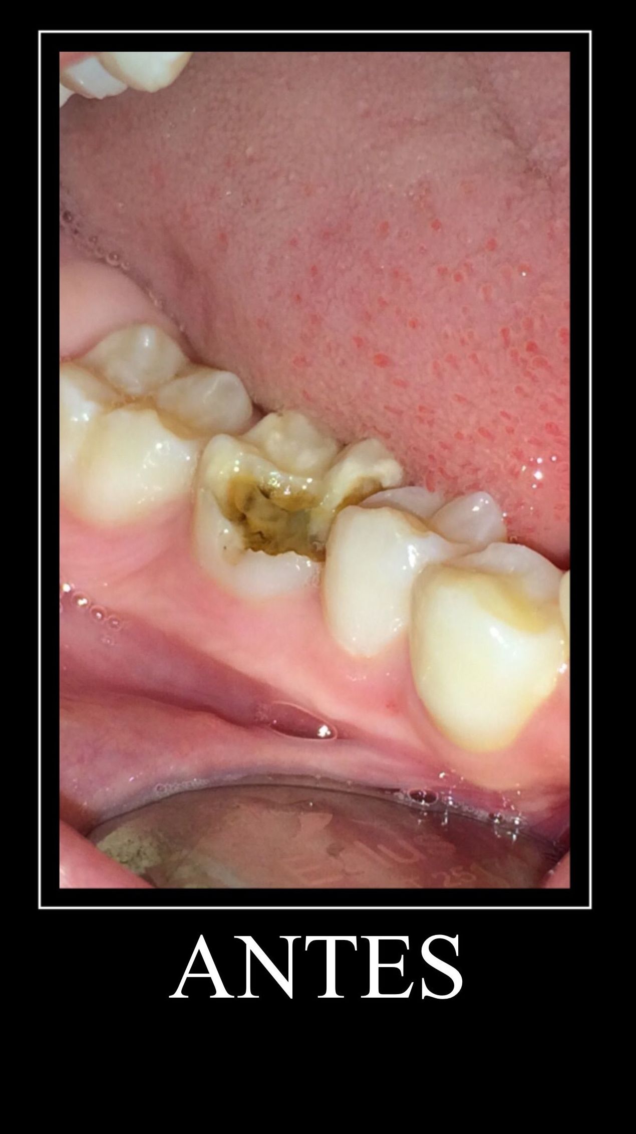 Empastes: Tratamientos de Clínica Dental Tucán Empastes: Tratamientos de Clínica Dental Tucán
