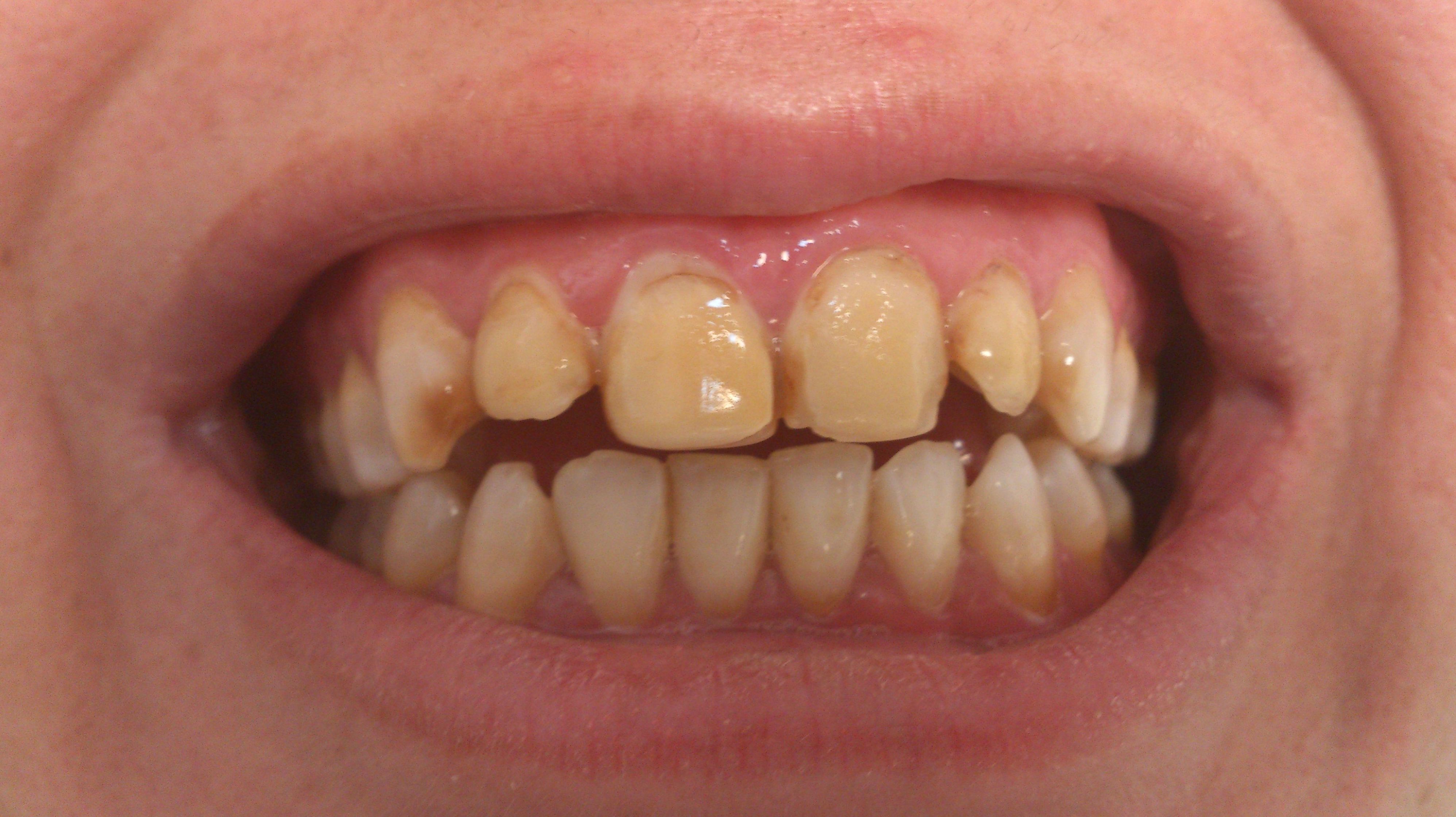 Carillas porcelana: Tratamientos de Clínica Dental Tucán Carillas porcelana: Tratamientos de Clínica Dental Tucán