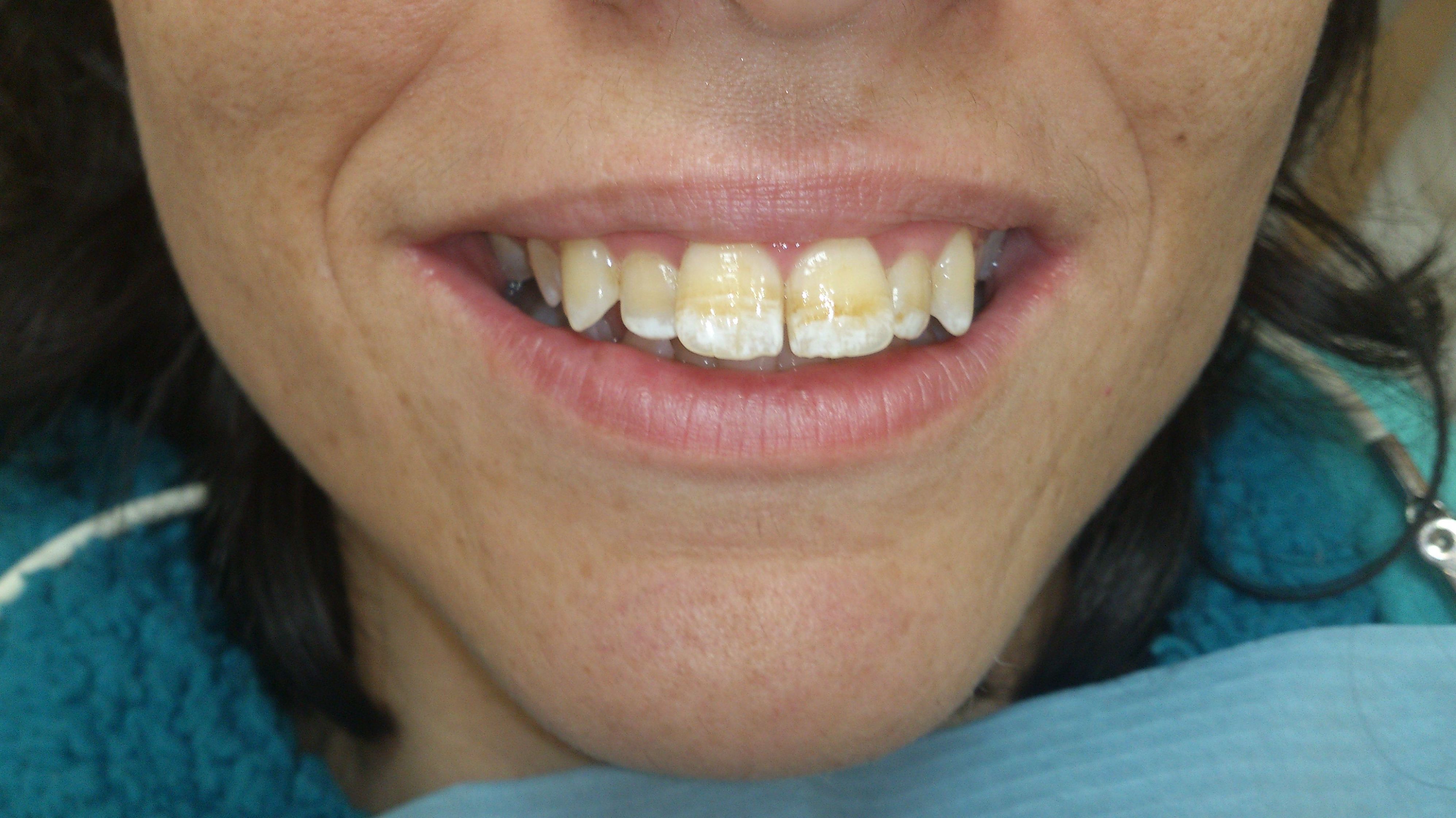 Carillas porcelana: Tratamientos de Clínica Dental Tucán Carillas porcelana: Tratamientos de Clínica Dental Tucán