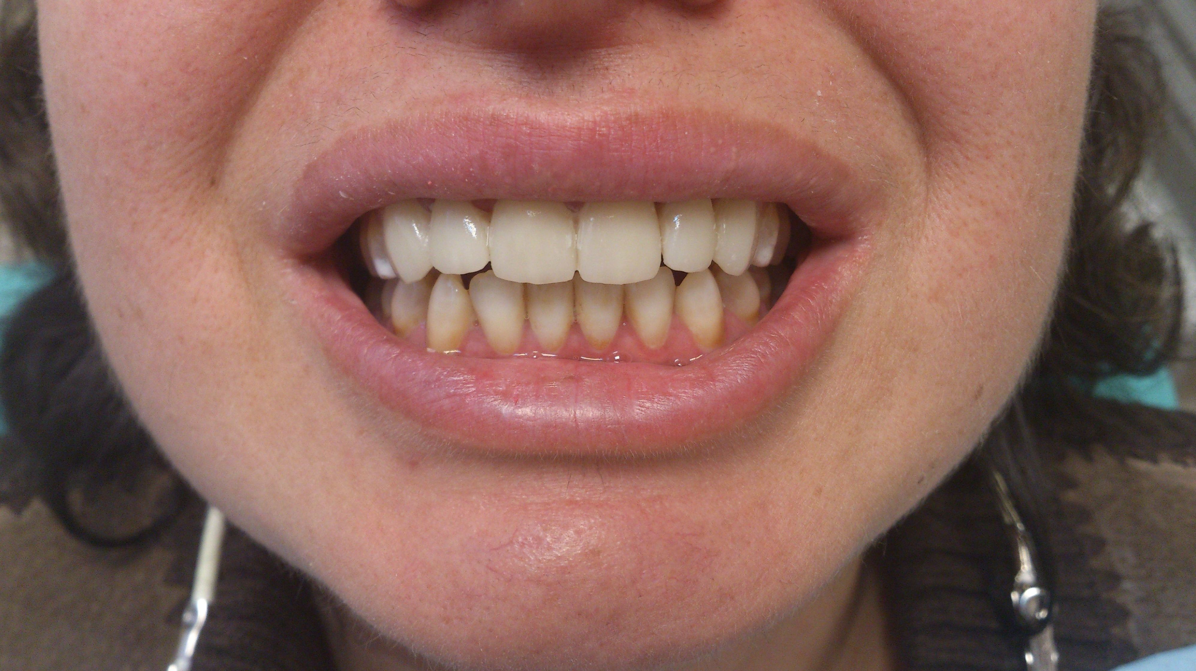 Carillas porcelana: Tratamientos de Clínica Dental Tucán Carillas porcelana: Tratamientos de Clínica Dental Tucán