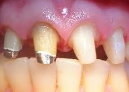 Pernos: Tratamientos de Clínica Dental Tucán Pernos: Tratamientos de Clínica Dental Tucán