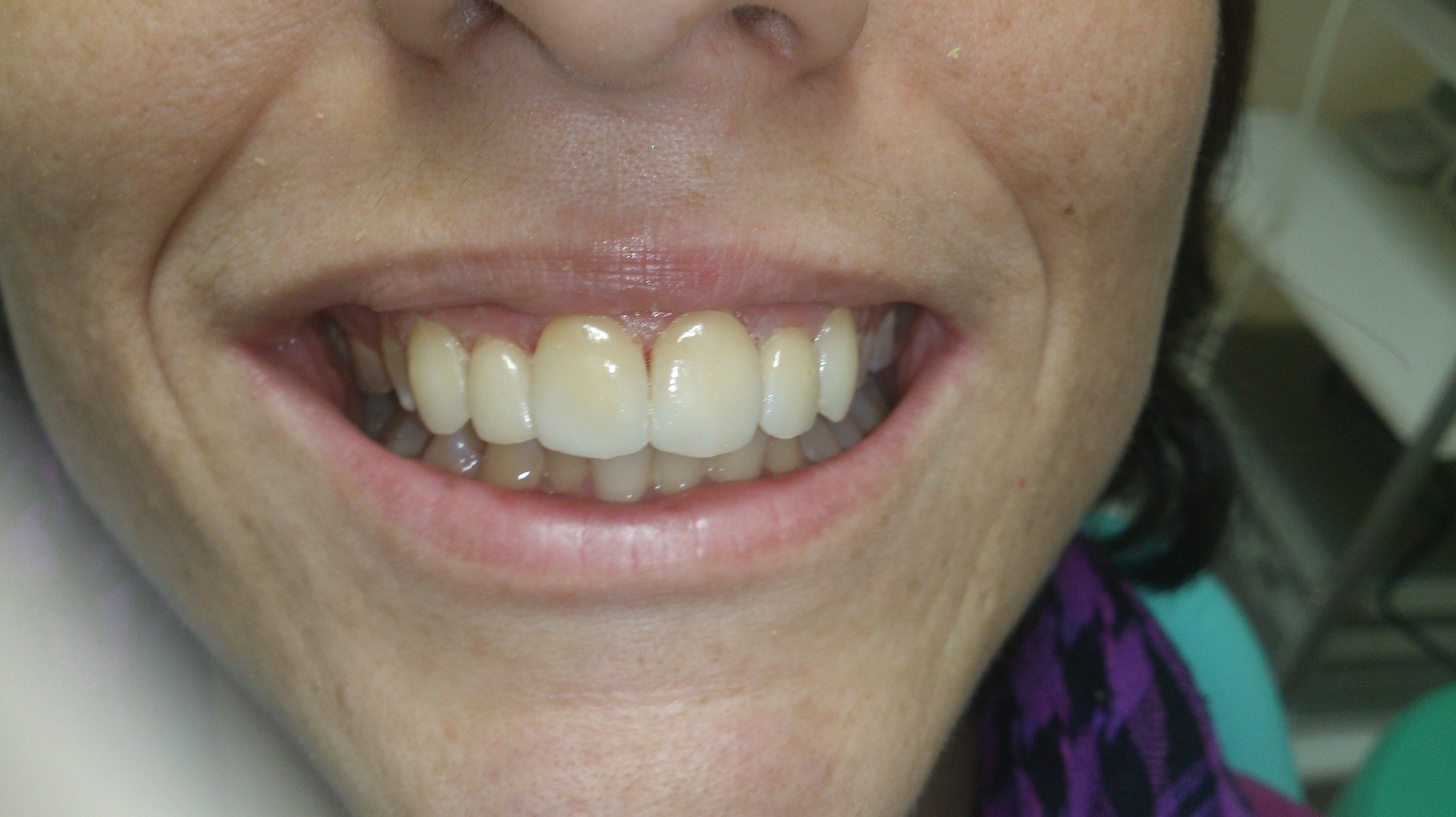 Carillas porcelana: Tratamientos de Clínica Dental Tucán Carillas porcelana: Tratamientos de Clínica Dental Tucán
