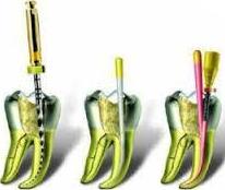 Re-endodoncia: Tratamientos de Clínica Dental Tucán Re-endodoncia: Tratamientos de Clínica Dental Tucán