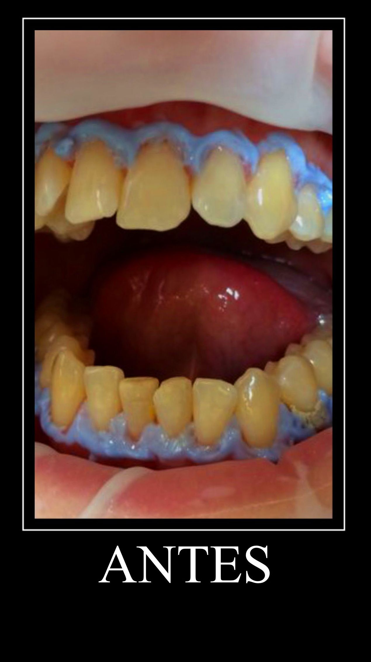 Blanqueamiento: Tratamientos de Clínica Dental Tucán Blanqueamiento: Tratamientos de Clínica Dental Tucán