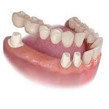 Puentes: Tratamientos de Clínica Dental Tucán Puentes: Tratamientos de Clínica Dental Tucán