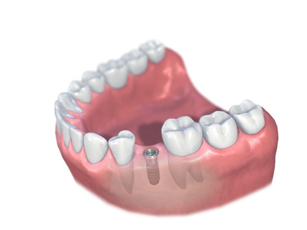 Implantes: Tratamientos de Clínica Dental Tucán Implantes: Tratamientos de Clínica Dental Tucán