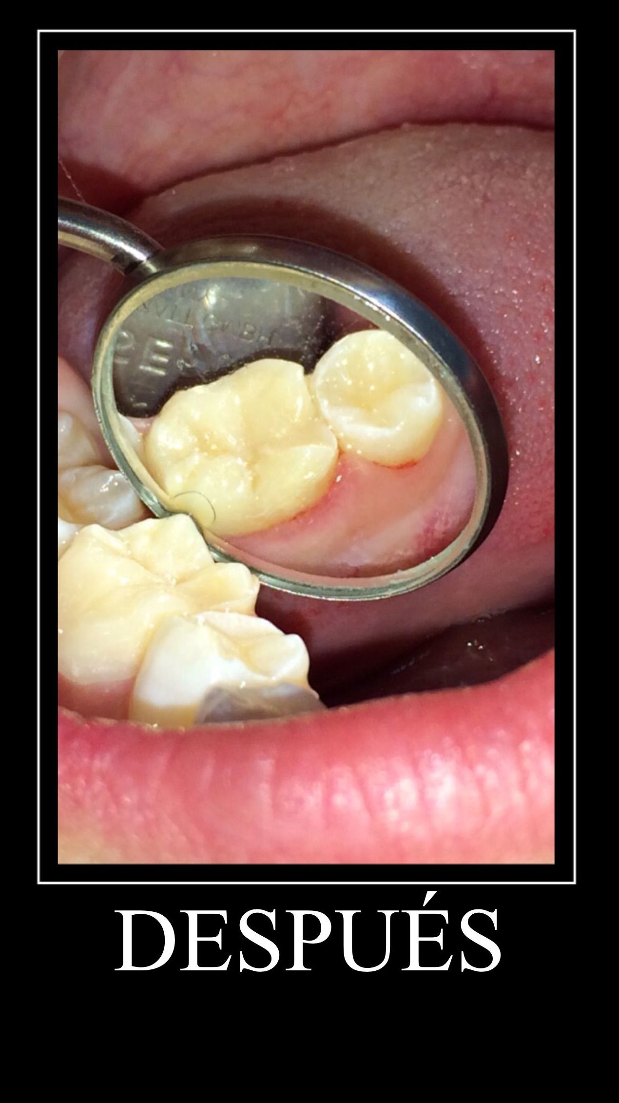 Empastes: Tratamientos de Clínica Dental Tucán Empastes: Tratamientos de Clínica Dental Tucán