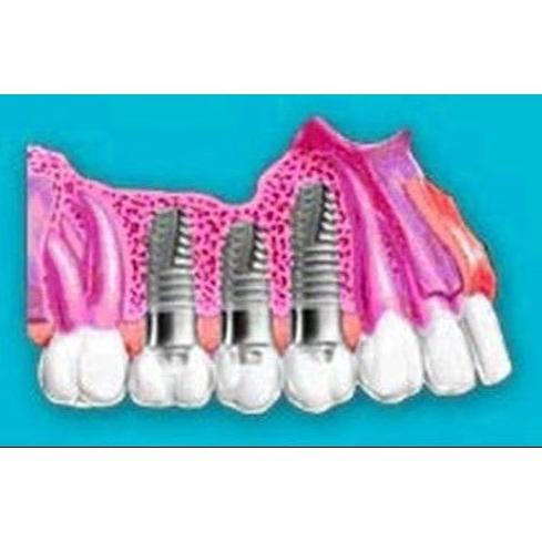 Implantes: Tratamientos de Angelina Castro Redondo Implantes: Tratamientos de Angelina Castro Redondo