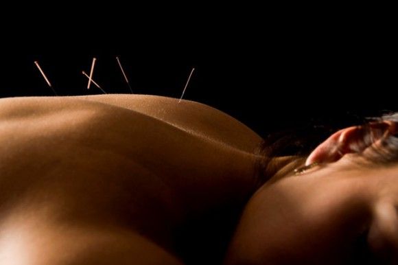 Tratamiento con acupuntura