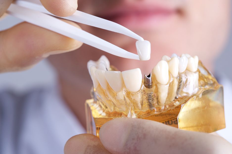 Implantes dentales al mejor precio en Valencia