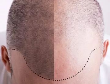 Caída del cabello: Tratamientos de Medicina Estética Profesional Caída del cabello: Tratamientos de Medicina Estética Profesional