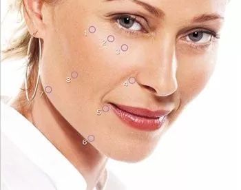 Lifting en 8 puntos: Tratamientos de Medicina Estética Profesional Lifting en 8 puntos: Tratamientos de Medicina Estética Profesional