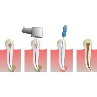 Endodoncia: Servicios de Future Centros Dentales Avanzados Endodoncia: Servicios de Future Centros Dentales Avanzados