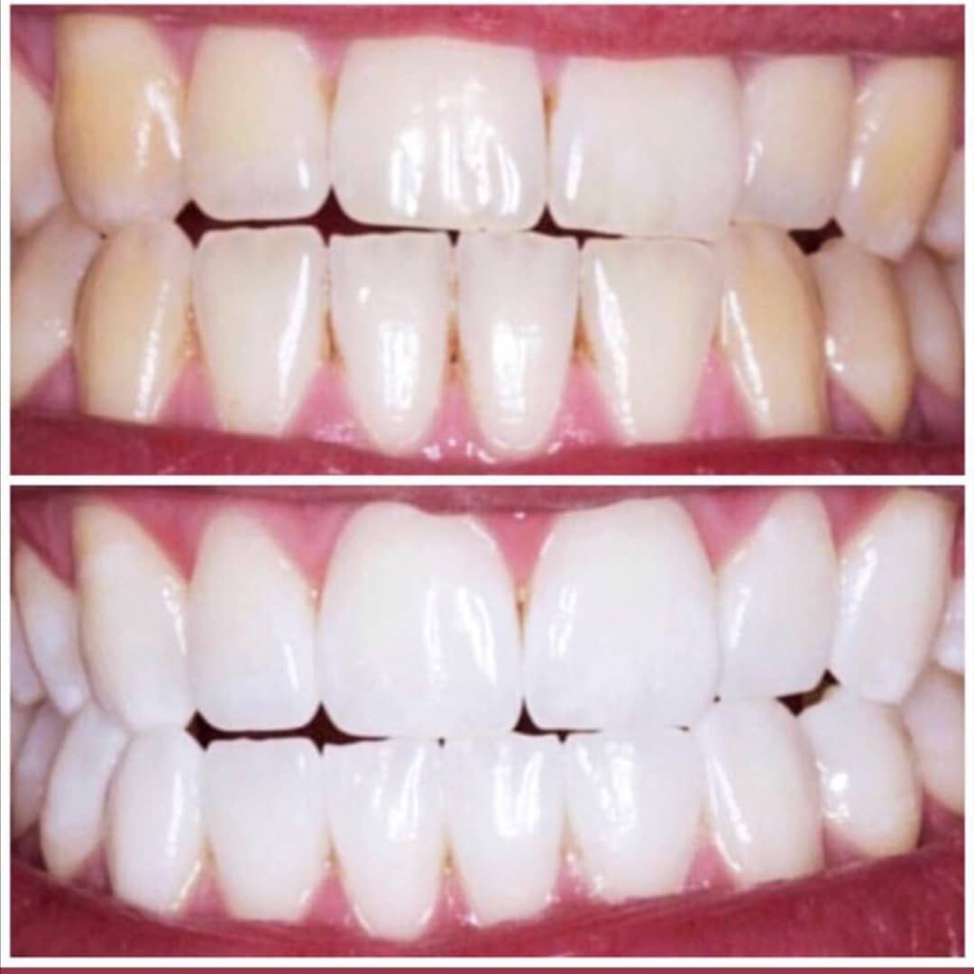 Limpiezas dentales estéticos: Productos de Adictos Tenerife Limpiezas dentales estéticos: Productos de Adictos Tenerife