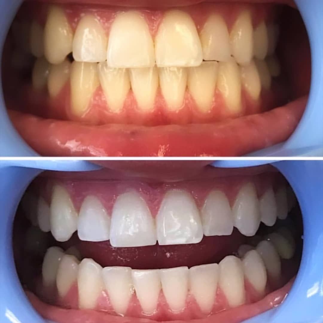 Limpiezas dentales estéticos: Productos de Adictos Tenerife Limpiezas dentales estéticos: Productos de Adictos Tenerife