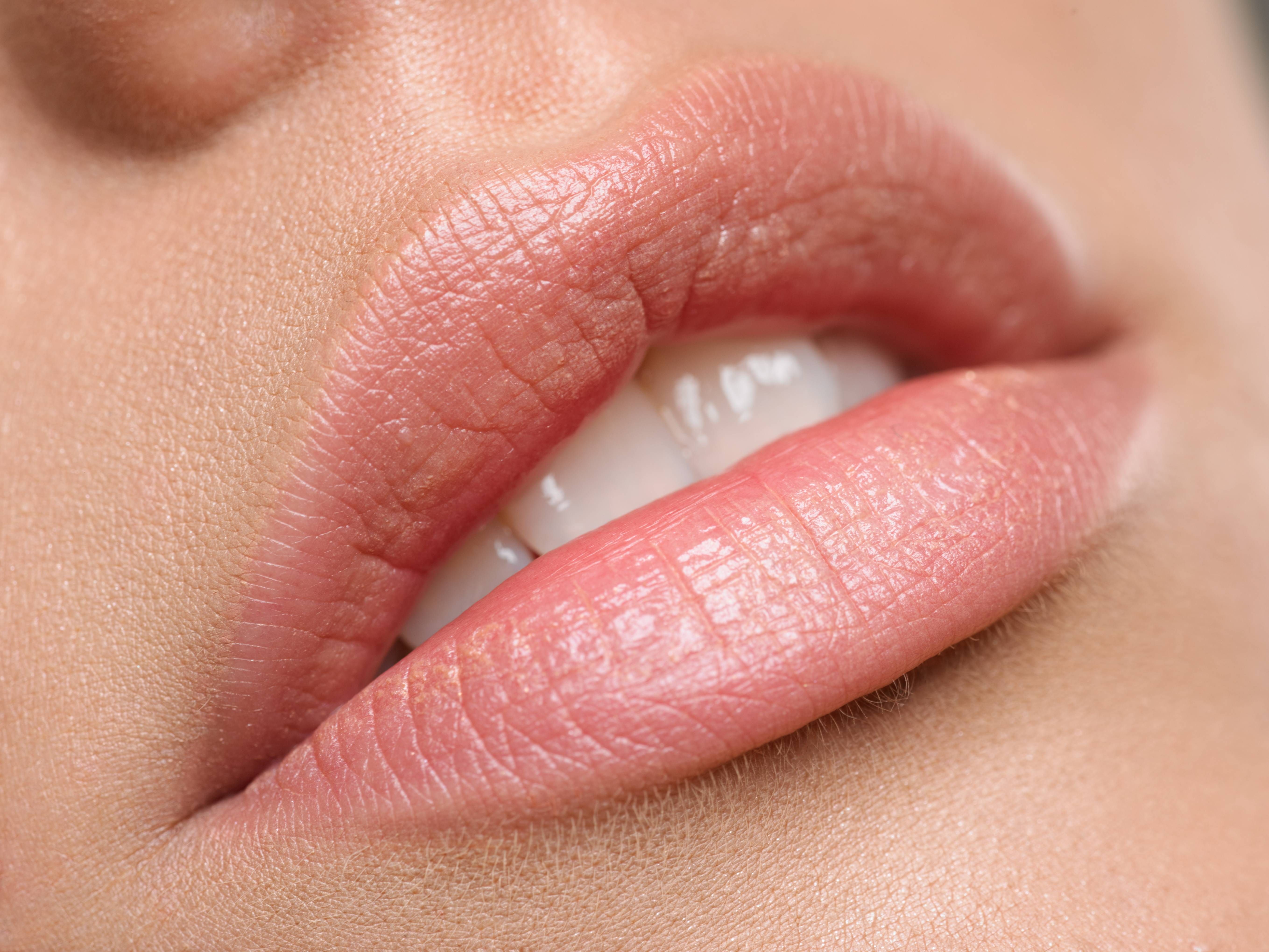Relleno de labios: Servicios de Estética de Medicina & Estética Glamour Relleno de labios: Servicios de Estética de Medicina & Estética Glamour