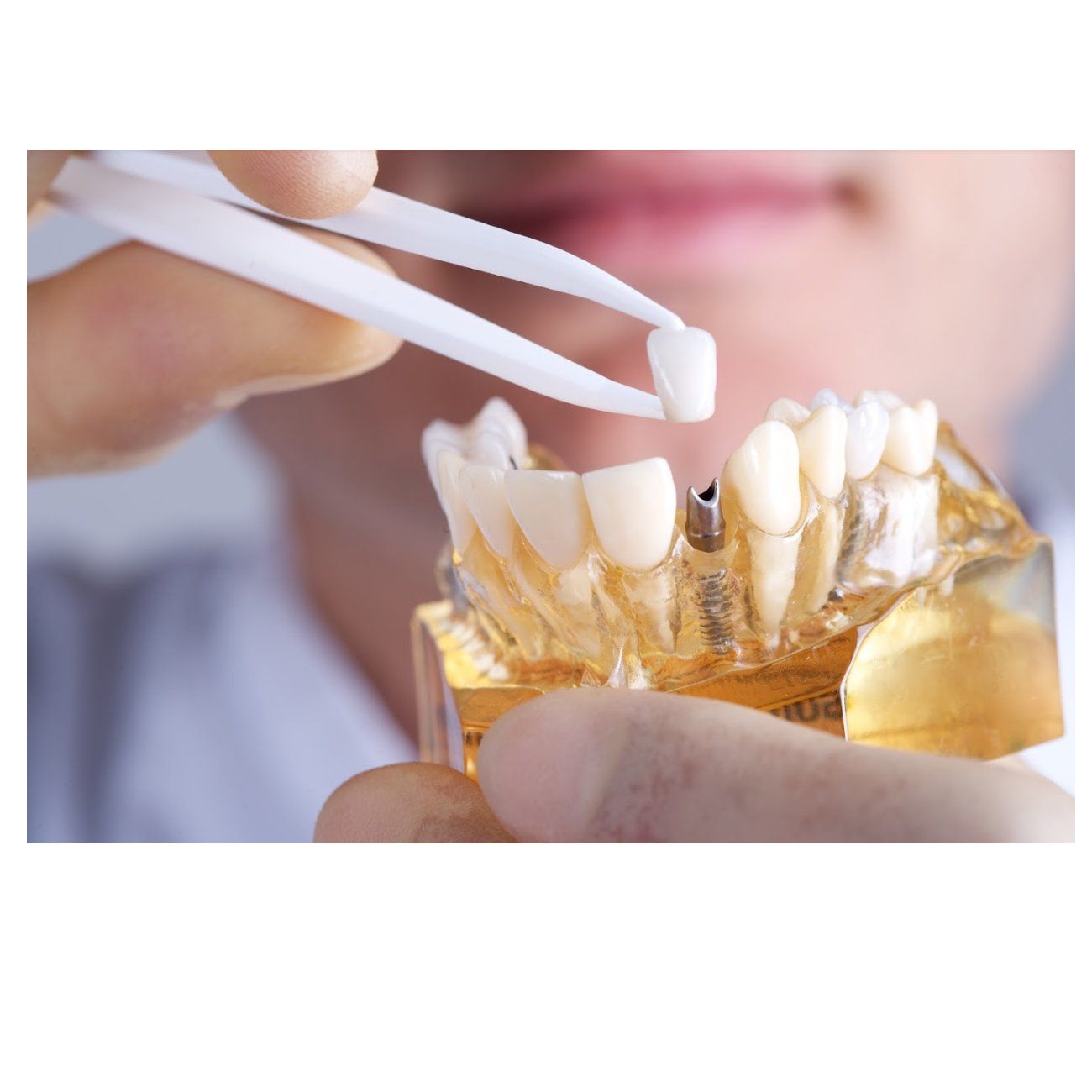 Implantes dentales Implantes dentales