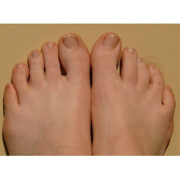 Uñas encarnadas: Tratamientos de Alicia Blasco Gutiérrez Uñas encarnadas: Tratamientos de Alicia Blasco Gutiérrez