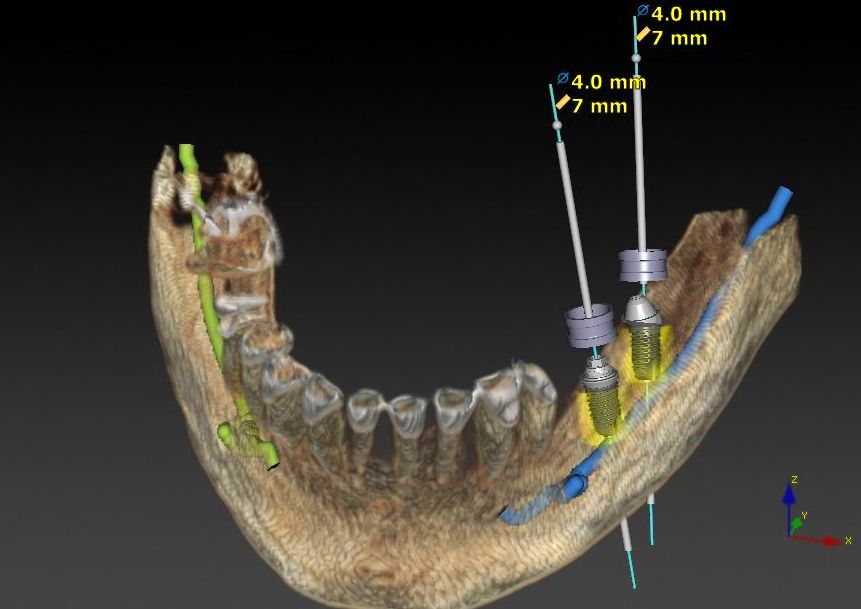 Implantología Guiada 3D