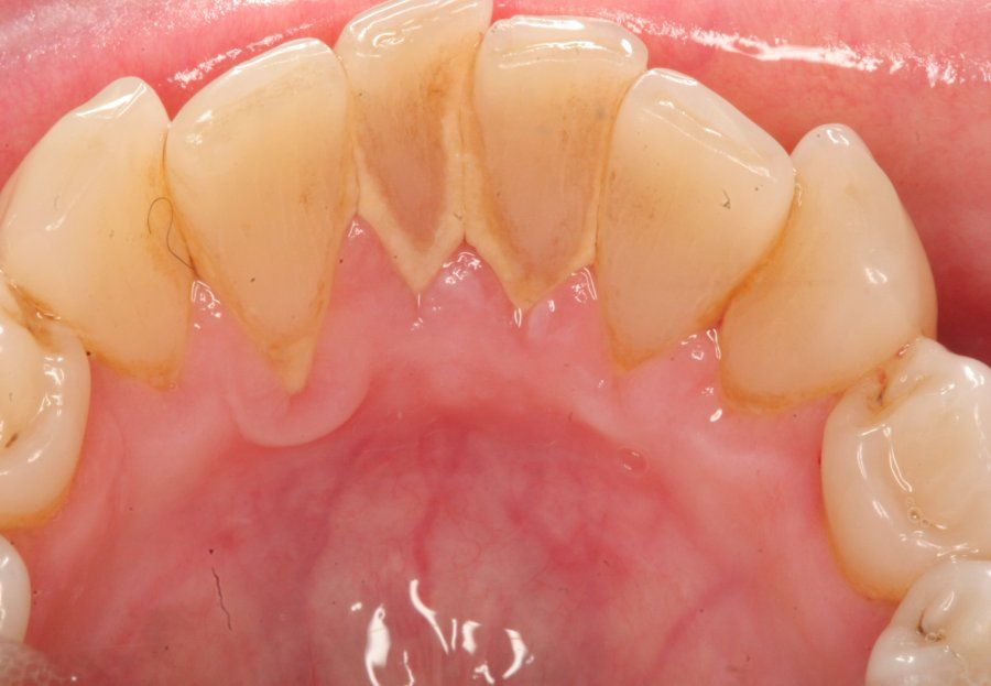 Clínicas dentales en Salou: enfermedades como caries y gingivitis