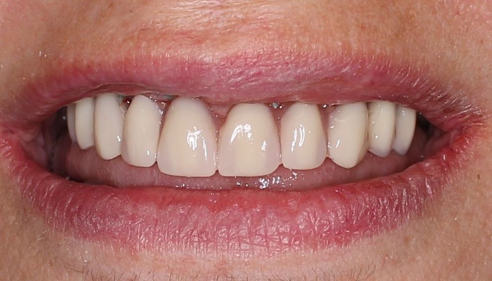 Foto 22 de Clínicas dentales en O Milladoiro | Clínica Implanteoral Milladoiro