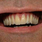 Implantes dentales: Servicios de Clínica Implanteoral Milladoiro Implantes dentales: Servicios de Clínica Implanteoral Milladoiro