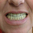 Prótesis dental: Servicios de Clínica Implanteoral Milladoiro Prótesis dental: Servicios de Clínica Implanteoral Milladoiro