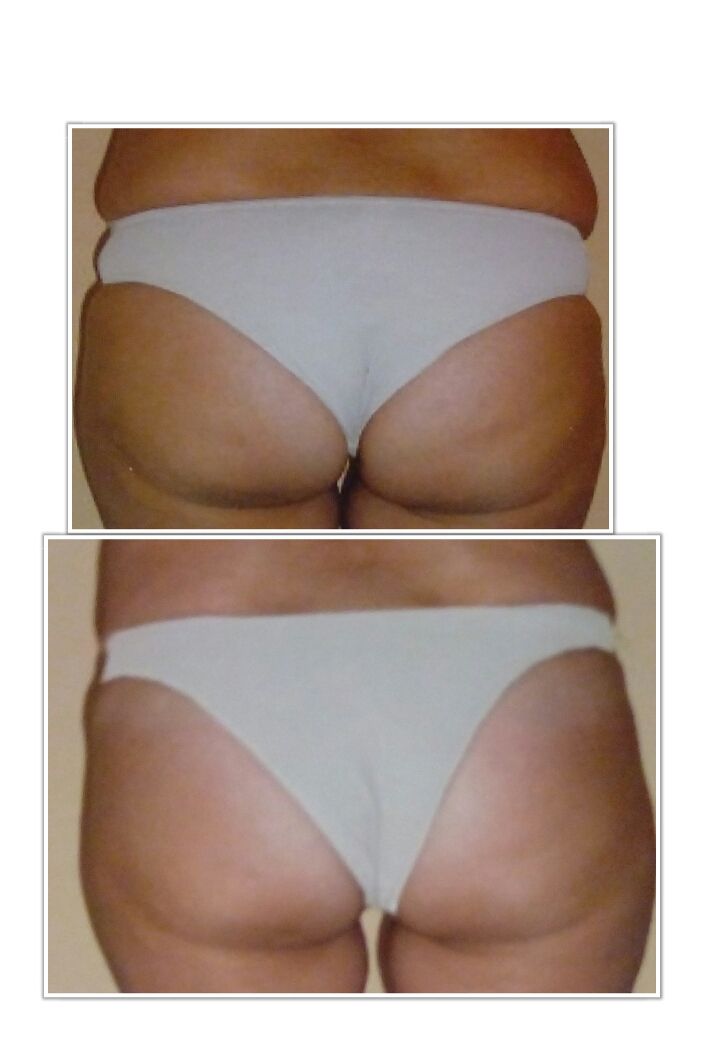 Remodelación corporal: Servicios de Salón de Belleza Sukaro Remodelación corporal: Servicios de Salón de Belleza Sukaro