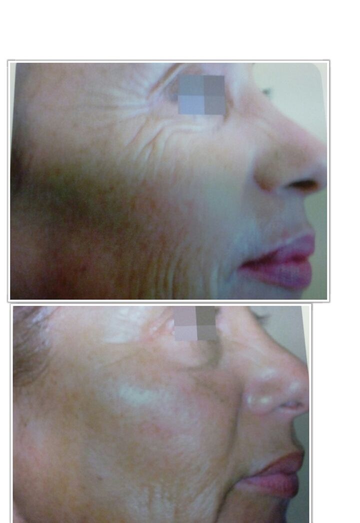 Rejuvenecimiento facial: Servicios de Salón de Belleza Sukaro Rejuvenecimiento facial: Servicios de Salón de Belleza Sukaro