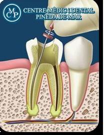 Endodoncia Pineda de Mar Endodoncia Pineda de Mar