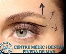 BLEFAROPLASTIA: Tratamientos de Centro Médico y Dental Pineda BLEFAROPLASTIA: Tratamientos de Centro Médico y Dental Pineda