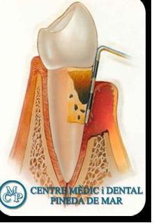 PERIODONCIA: Tratamientos de Centro Médico y Dental Pineda PERIODONCIA: Tratamientos de Centro Médico y Dental Pineda