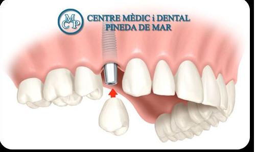 PRÓTESIS DENTAL: Tratamientos de Centro Médico y Dental Pineda PRÓTESIS DENTAL: Tratamientos de Centro Médico y Dental Pineda