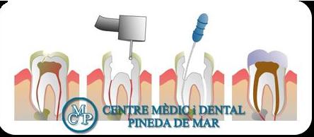 ENDODONCIA: Tratamientos de Centro Médico y Dental Pineda ENDODONCIA: Tratamientos de Centro Médico y Dental Pineda