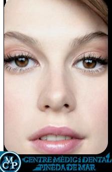 RINOPLASTIA EN PINEDA RINOPLASTIA EN PINEDA