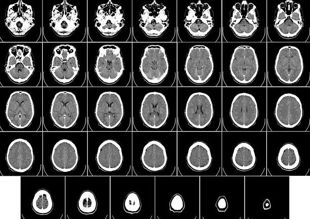 Tomografía computada (TC): Especialidades de Neurología de Lainez Andrés, J.M Tomografía computada (TC): Especialidades de Neurología de Lainez Andrés, J.M