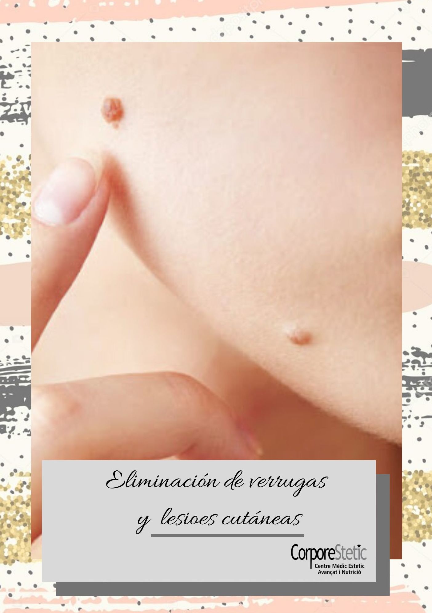 Eliminaión de verrugas y lesiones de la piel: Tratamientos de Corporestetic Eliminaión de verrugas y lesiones de la piel: Tratamientos de Corporestetic