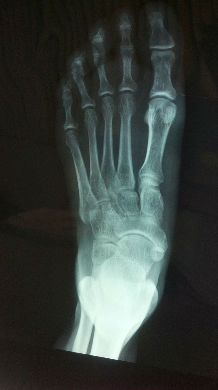 Radiografía del pie