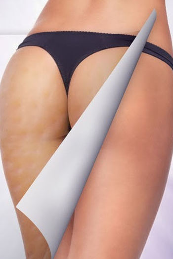 celulitis celulitis