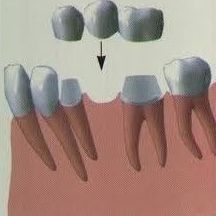 ¿Tengo hueso para colocar implantes?: Especialidades de Clínica Dental Medicalia Fuenlabrada, tus dentistas de confianza ¿Tengo hueso para colocar implantes?: Especialidades de Clínica Dental Medicalia Fuenlabrada, tus dentistas de confianza